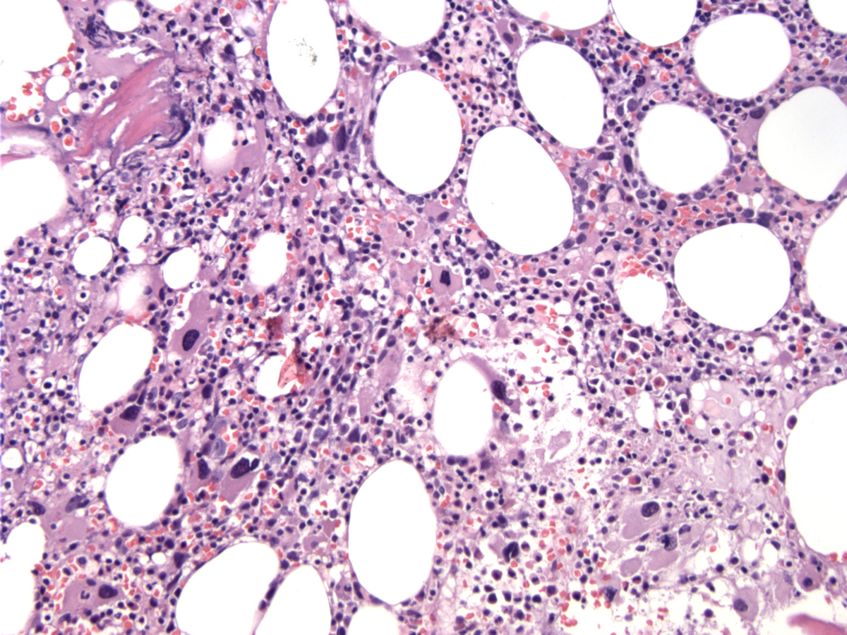 Bone marrow core biopsy section (BM-1), H&E stain, x200